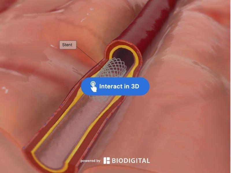 Completed intercranial stent project in interactive 3D.
